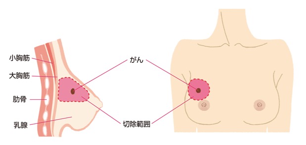 乳房部分切除(乳房温存術)