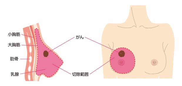 乳房切除術