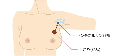 主な乳腺疾患