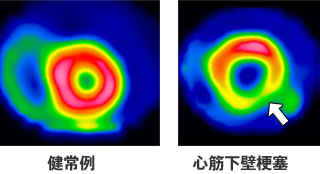 冠動脈疾患の危険性の高い病気は？