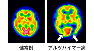 認知症とは