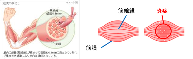 湿布が効く痛み