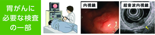 胃がんの診断・治療